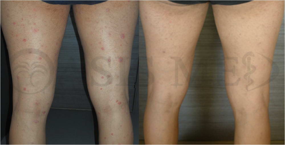 before after 11