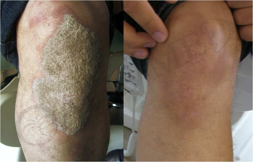 before after 1