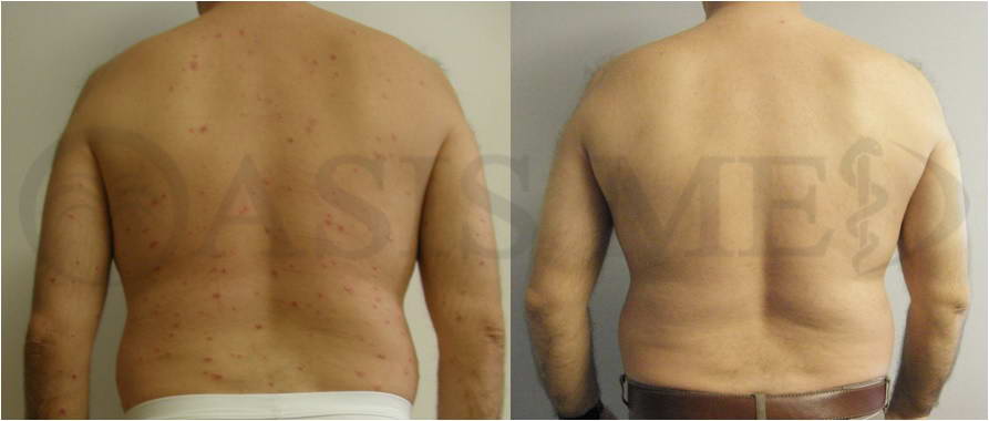 before after 4